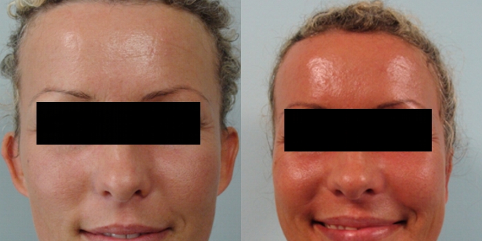 Otoplasty,  after 7 days